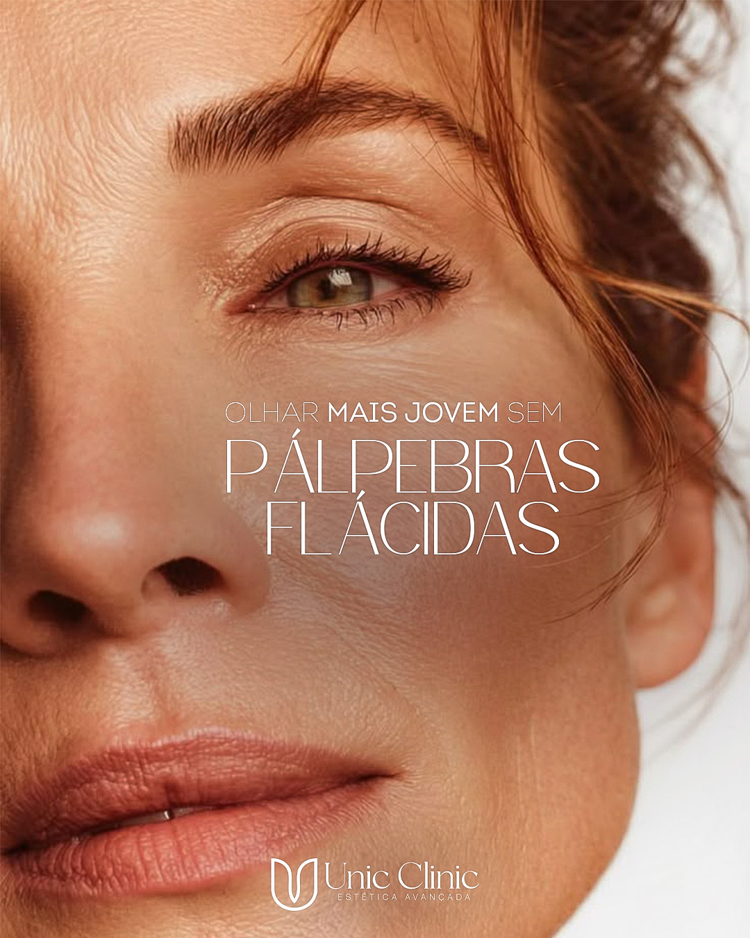 Flacidez de Pálpebras