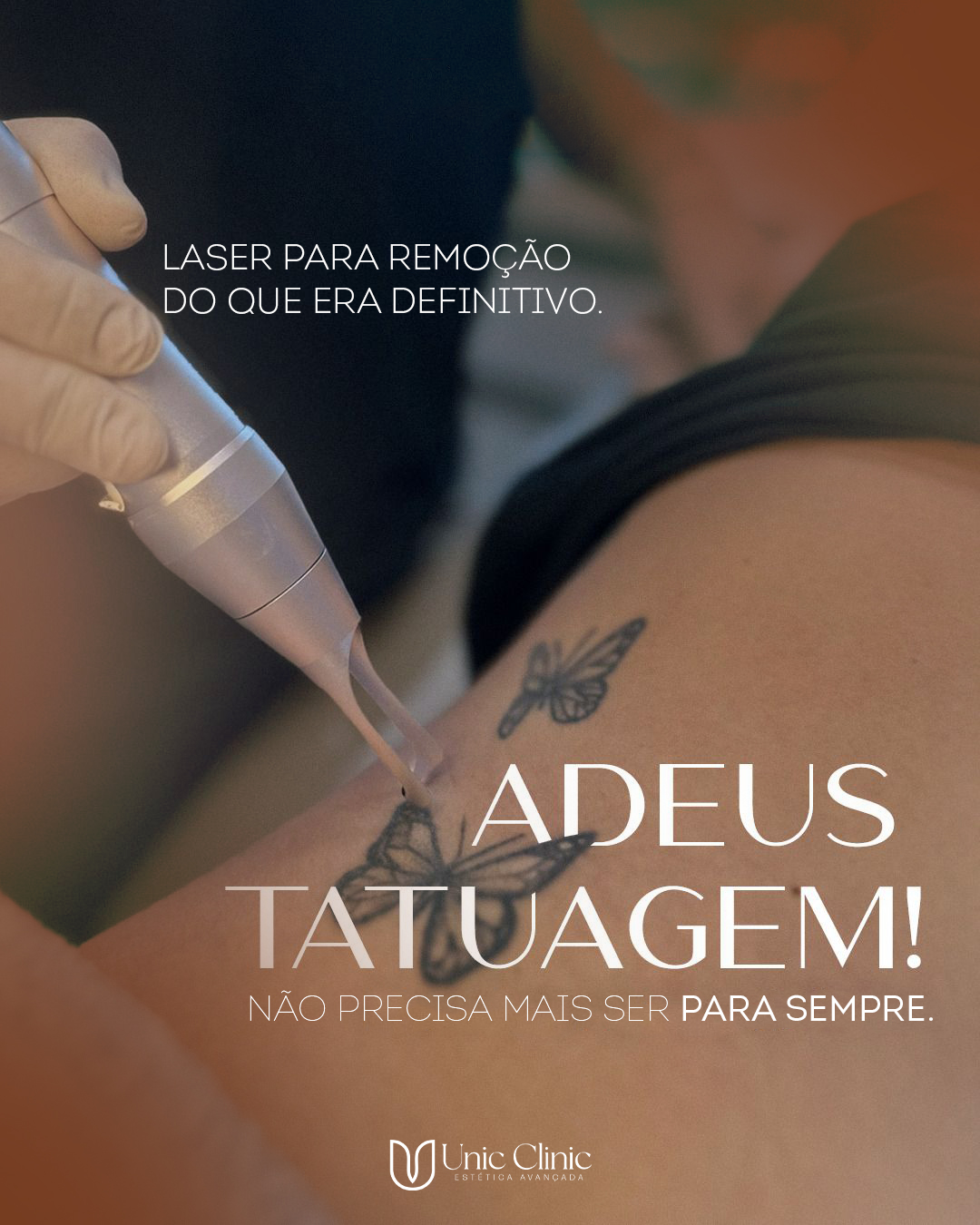 Remoção de Tatuagem